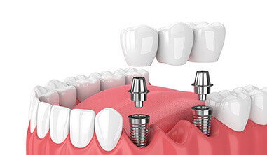 Dental Bridges
